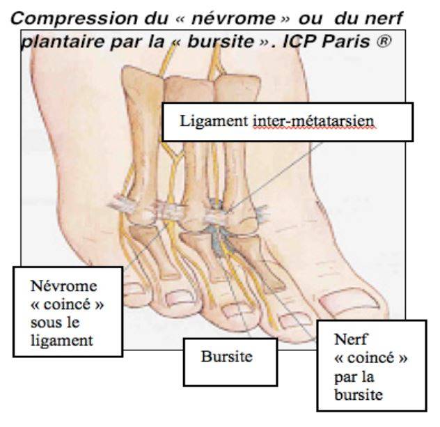 Le syndrome de Morton affecte les nerfs du pied et se traduit par ...