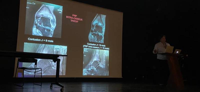 Intervention du Docteur Christophe Cermolacce, chirurgien orthopédiste (Paris - Marseille) à la Journée de Médecine et de Traumatologie du Sport, à Ajaccio