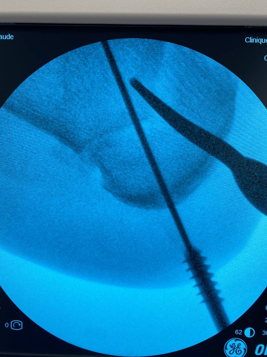 ostéotomie  calcaneum ICP PARIS 